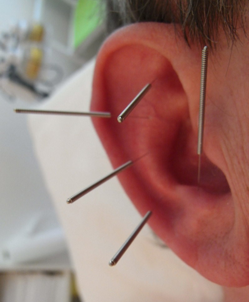 Ein Ohr mit Nadeln